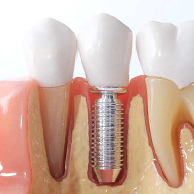 Mejor Clínica Implantes